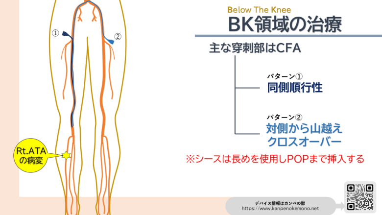 BK EVT approach