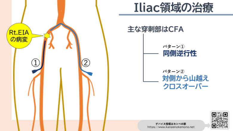 Iliac EVT approach
