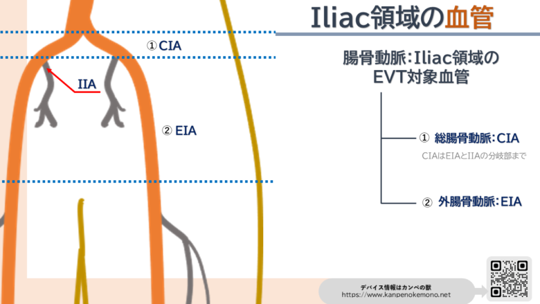腸骨動脈:ILIAC領域の血管画像