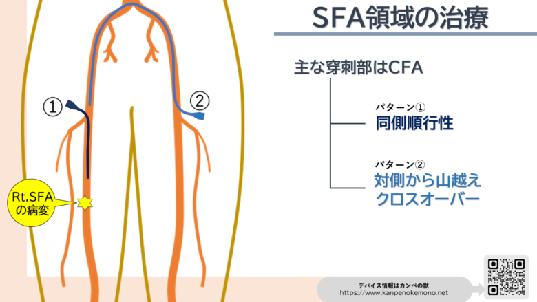 SFA EVT approach