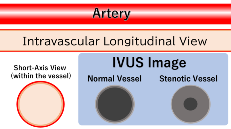 Types and Specifications of Intravascular Ultrasound (IVUS) | カンペの獣